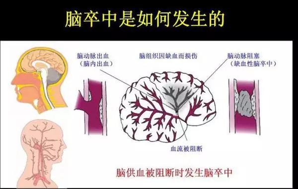 中国人死亡第一元凶不是癌症，而是脑卒中！