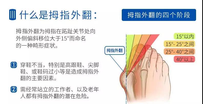 拇趾外翻大脚骨，穿鞋走路都犯愁！全国知名足踝专家来聊坐诊、手术，预约从速