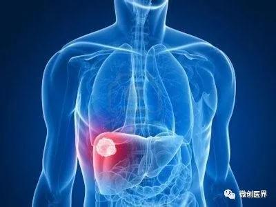 老年体检发现“肝囊肿”，是不是肿瘤？该怎么办？