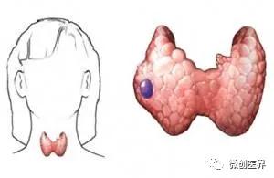 心慌、盗汗？可能患上了甲状腺结节！小心会恶变
