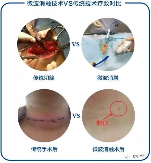 心慌、盗汗？可能患上了甲状腺结节！小心会恶变